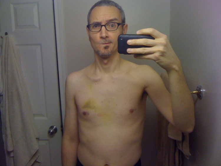 Последствия после перелома грудины thumbnail