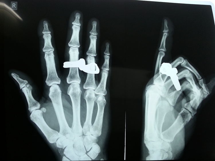 Переломах костей руки схема