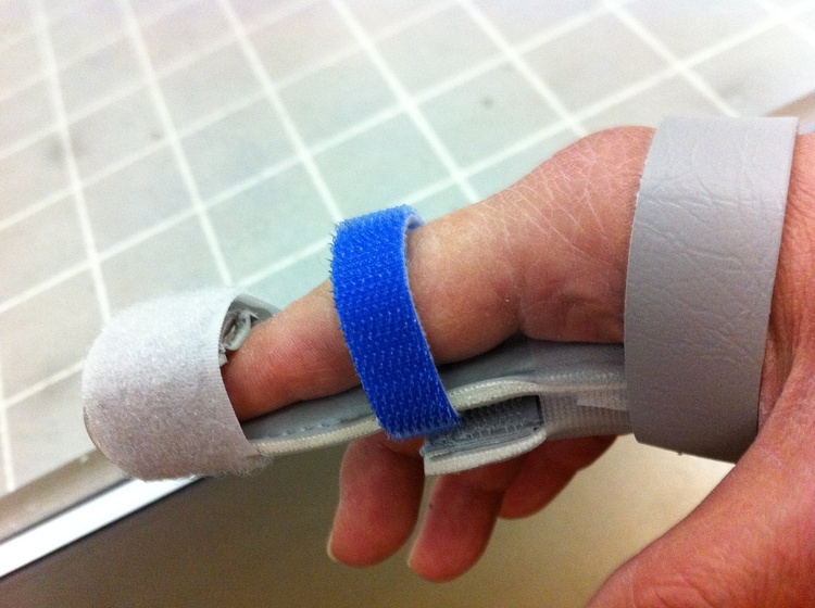 Признаки перелома пальца на руке