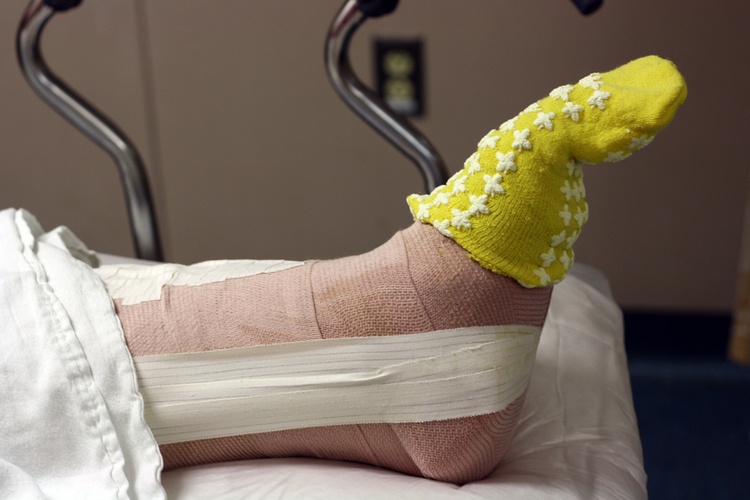 Лечение осколочного перелома ноги
