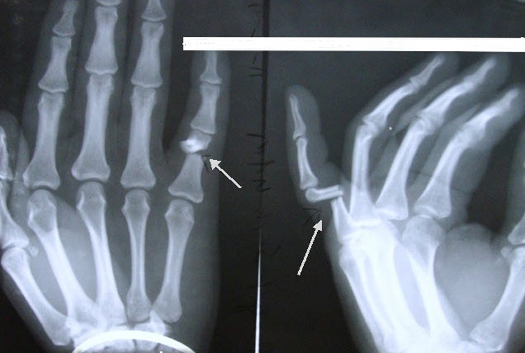 Переломы и трещины пальцев рук