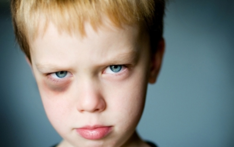 Сколько заживает синяк под глазом от удара и как предотвратить его появление?