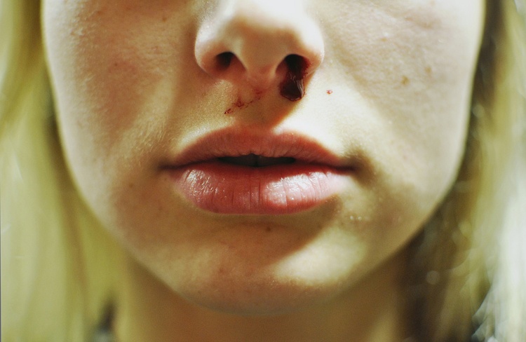 Ушиб носа: степень и тяжесть, симптомы, первая помощь в домашних условиях и методы лечения