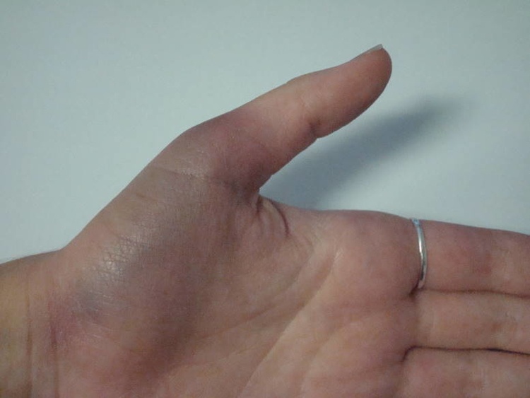 Ушиб средней фаланги пальца руки