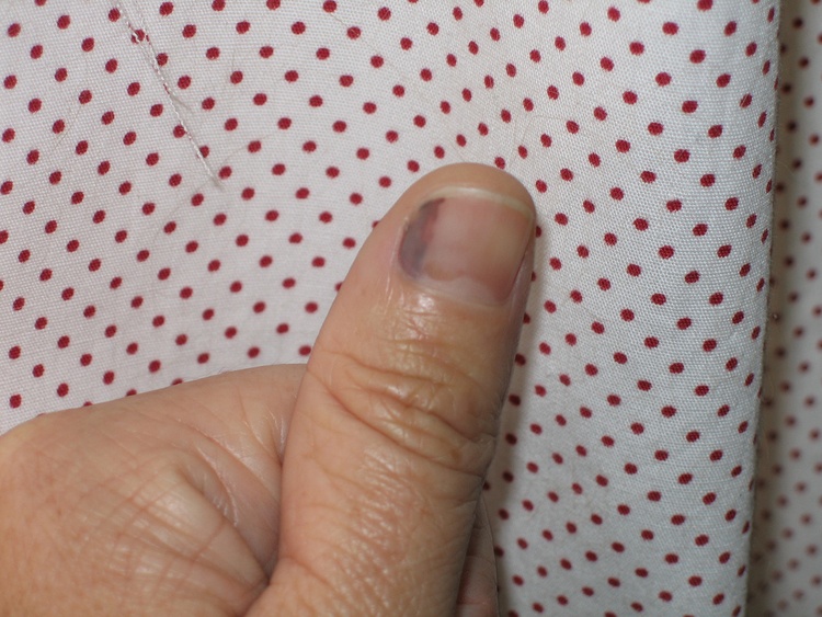 Как вылечить ушиб ногтя руки